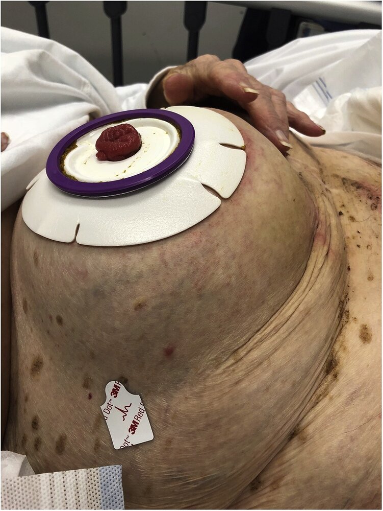 Parastomal hernia