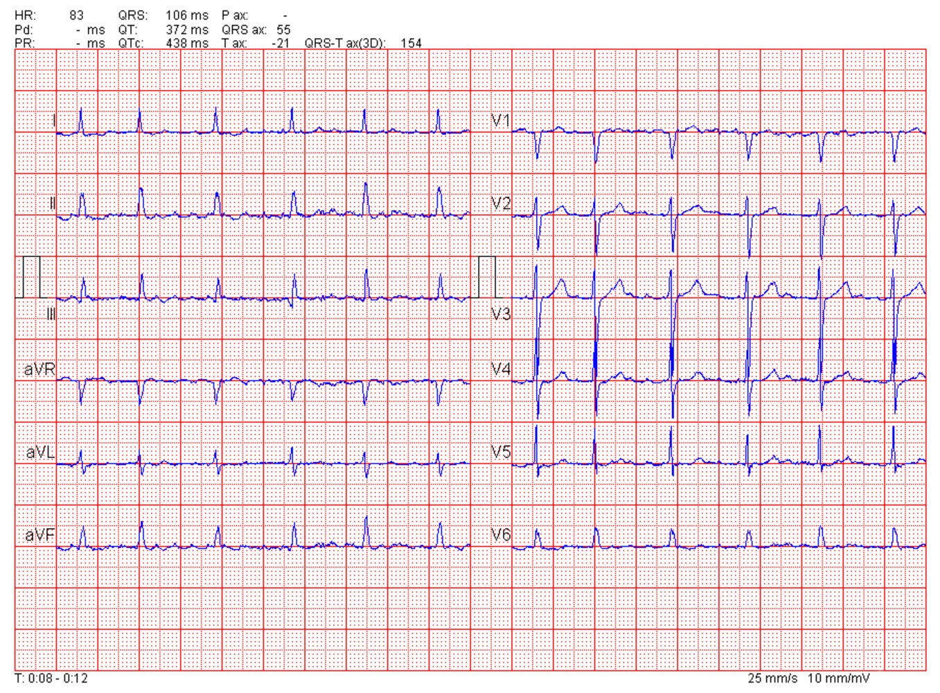 Atrial fibrillation