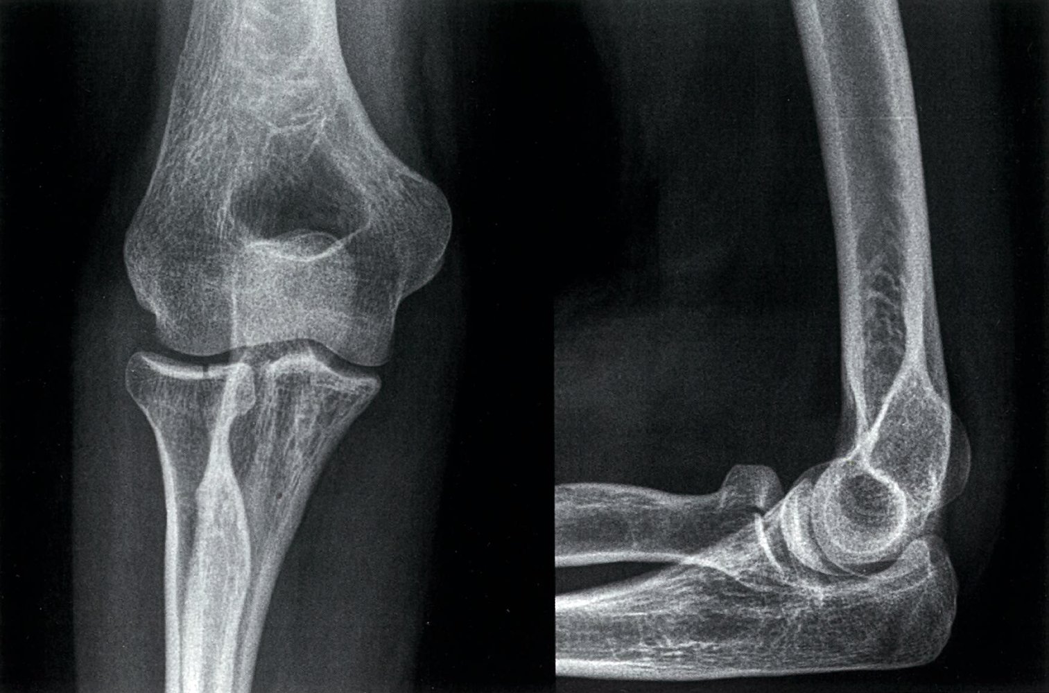 Radial head fracture
