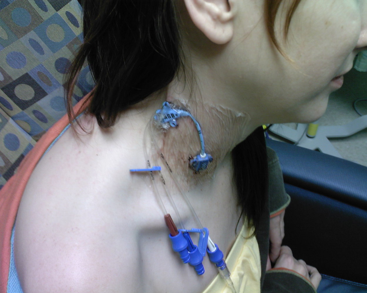 Central venous catheter (CVC)