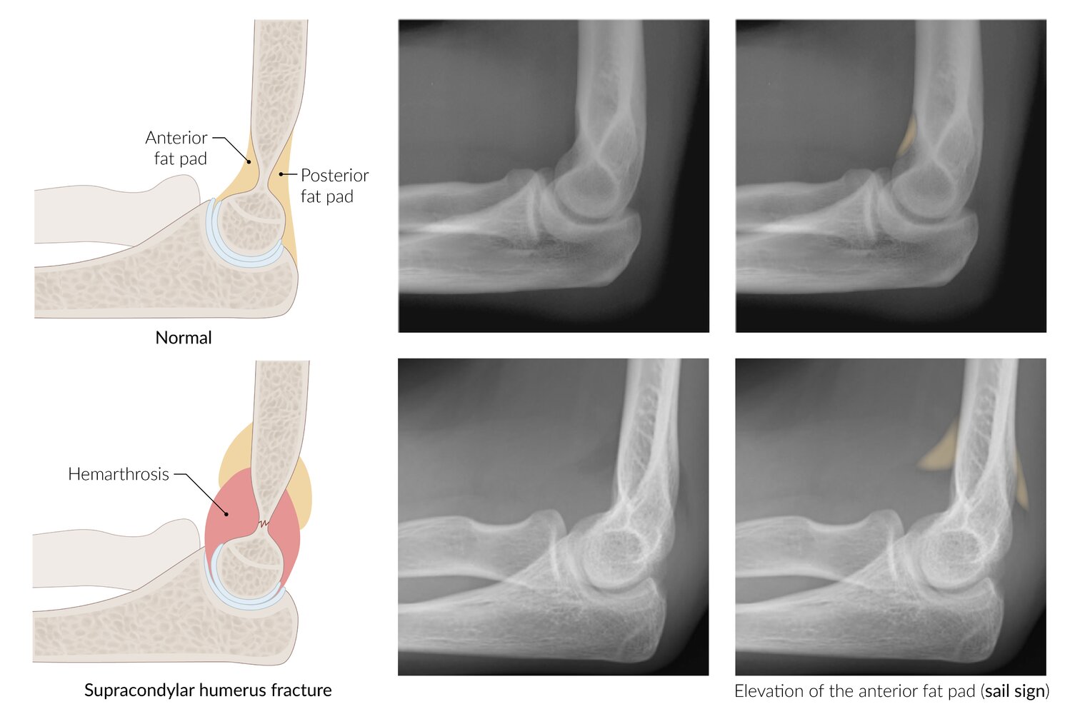 Anterior and posterior fat pad signs in supracondylar humerus fracture
