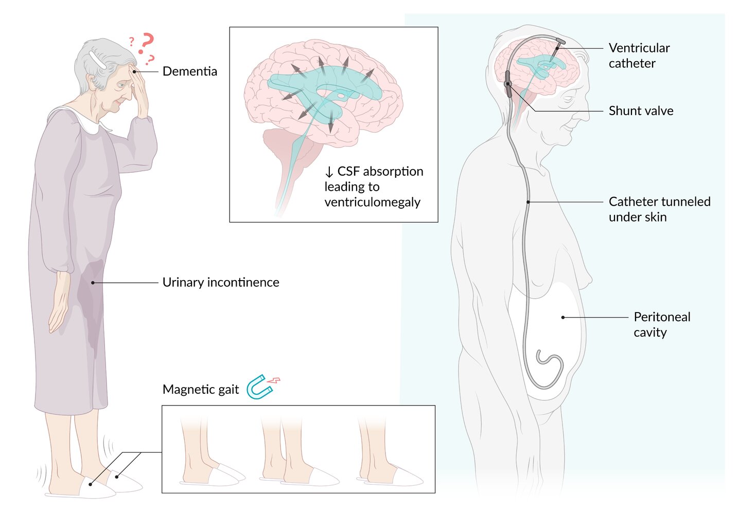 Normal pressure hydrocephalus