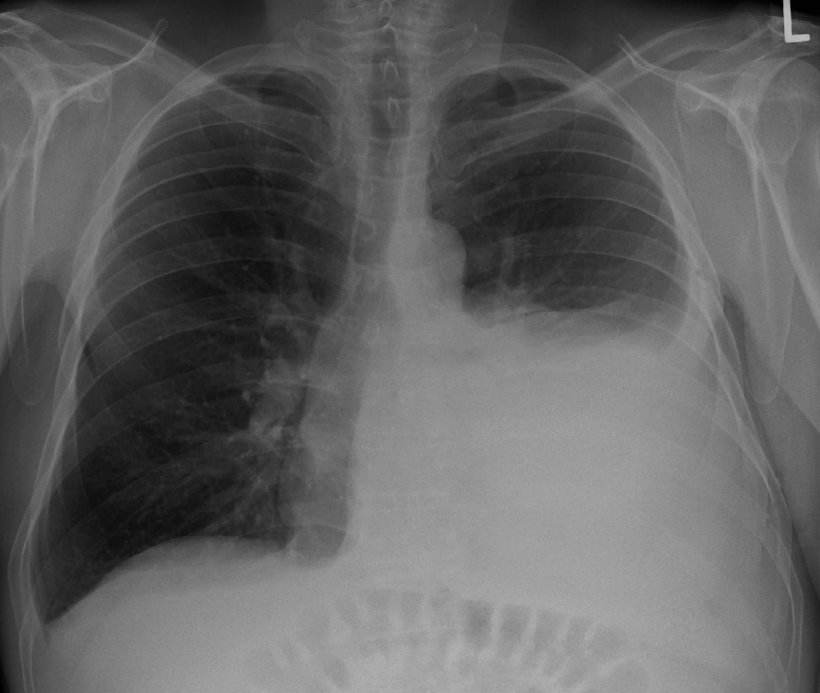 Pleural effusion and passive atelectasis