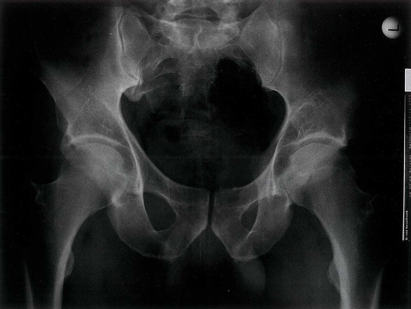 Chondrosarcoma