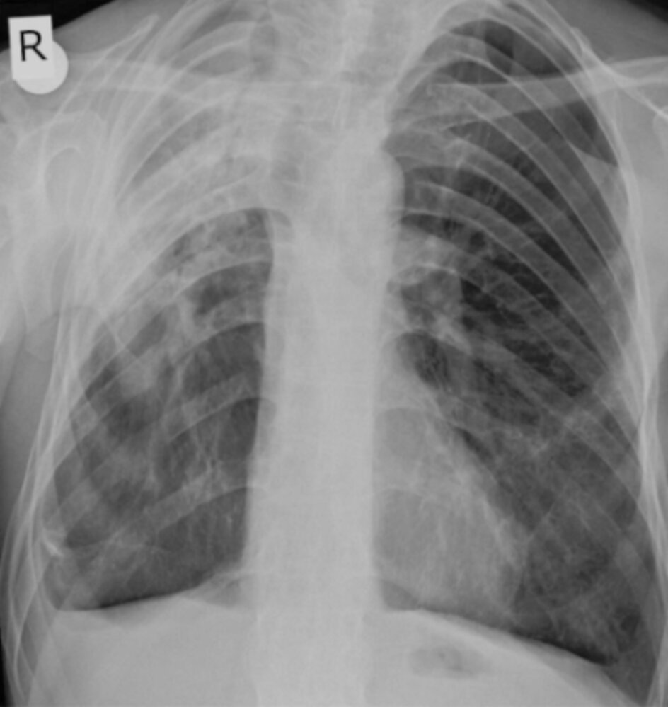 Upper lobe pulmonary fibrosis
