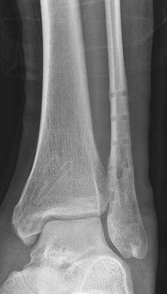 Bimalleolar fracture after hardware removal (2/2)