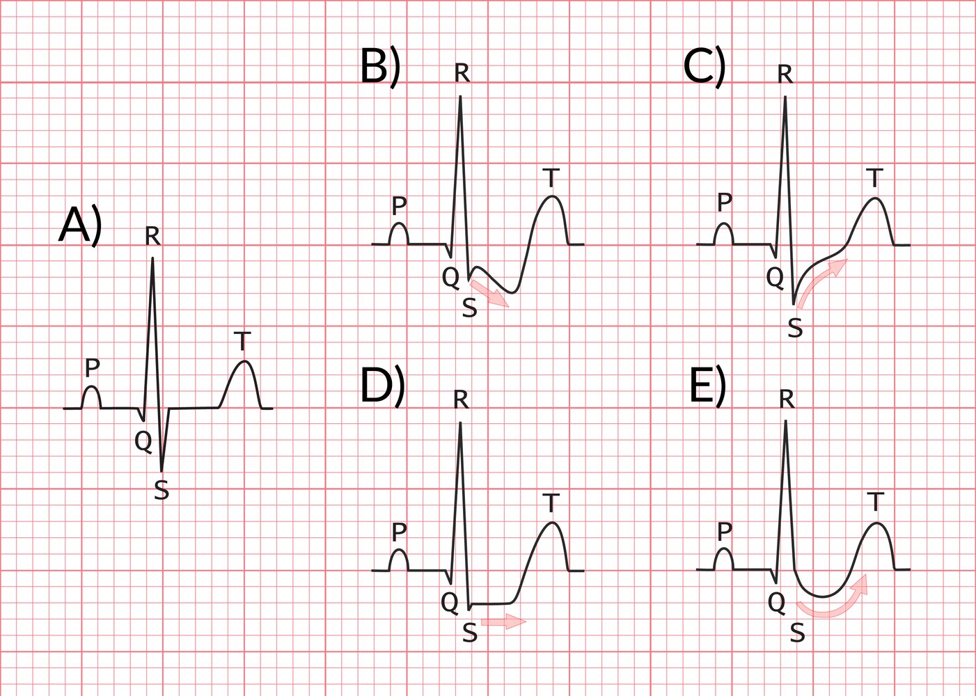 Types of ST segment depression