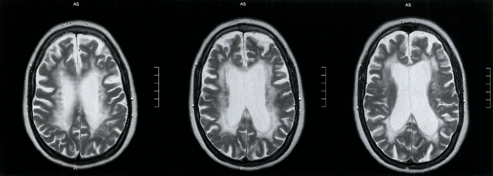 Multiple sclerosis; disease progression (2/2)