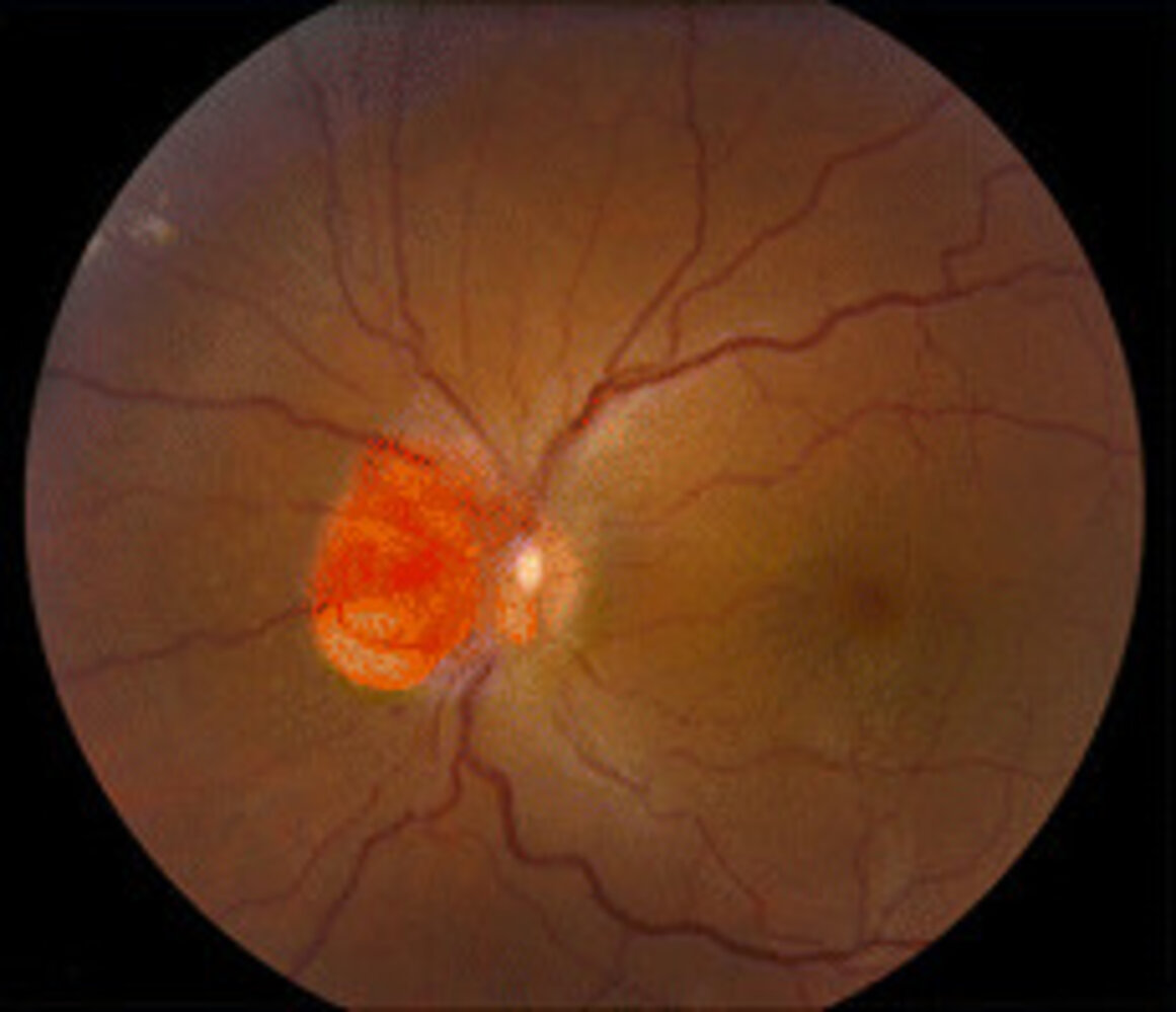 Retinal hemangioblastoma in von Hippel-Lindau disease