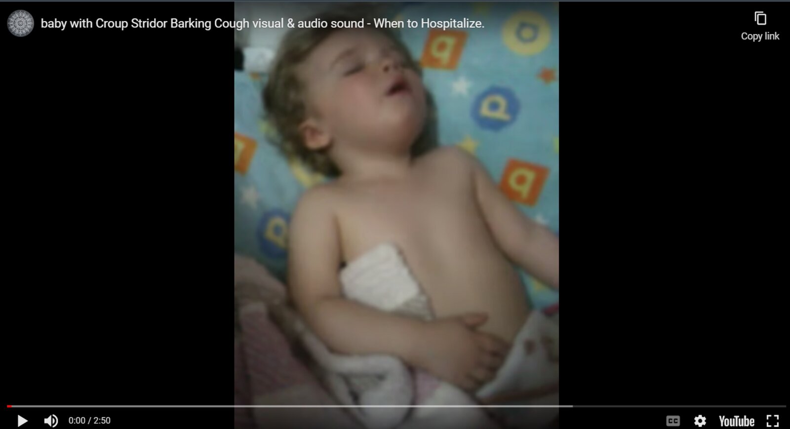 Barking cough, inspiratory stridor und chest retractions in viral croup | External video