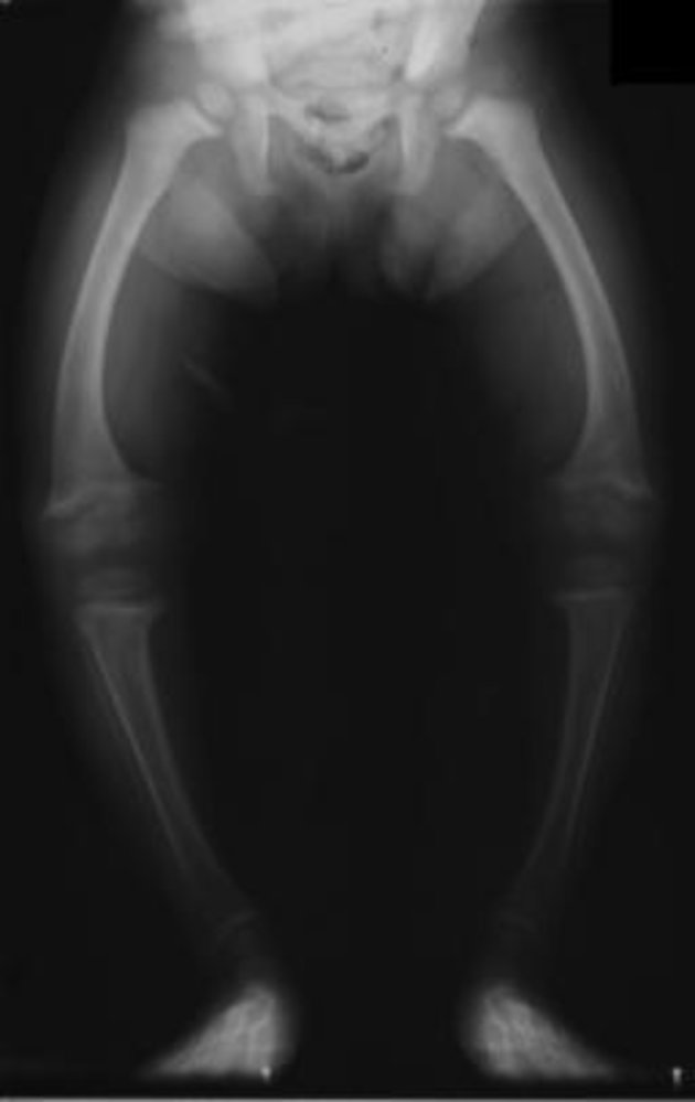 Rickets of the lower extremities