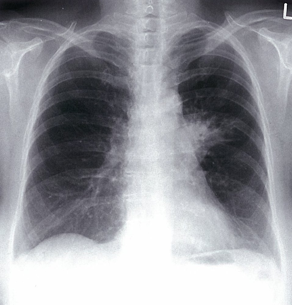 Left upper lobe airspace consolidation 1/2