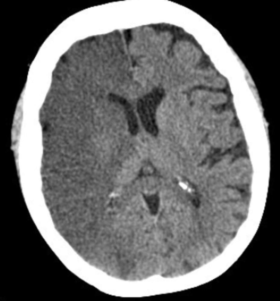 Acute ischemic stroke with hyperdense middle cerebral artery sign