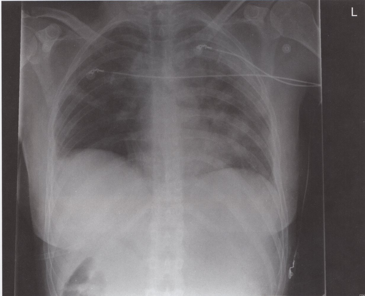 Multifocal opacities in bronchopneumonia