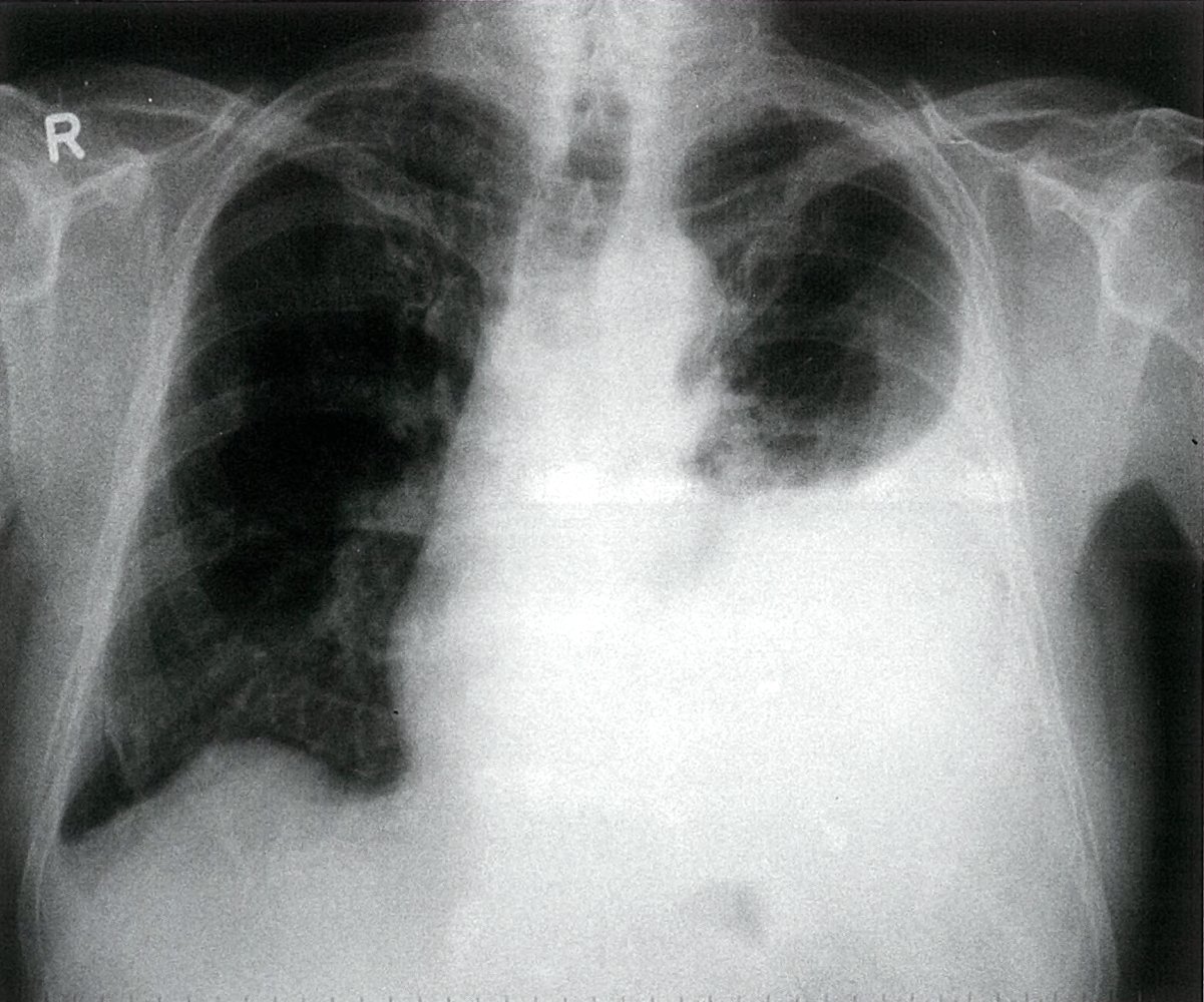 Left-sided pleural effusion in malignant mesothelioma (1/2)