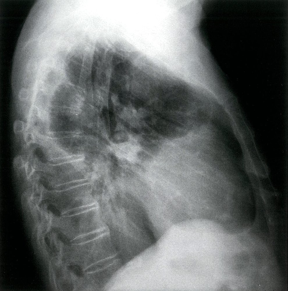 Left-sided pleural effusion in malignant mesothelioma (2/2)
