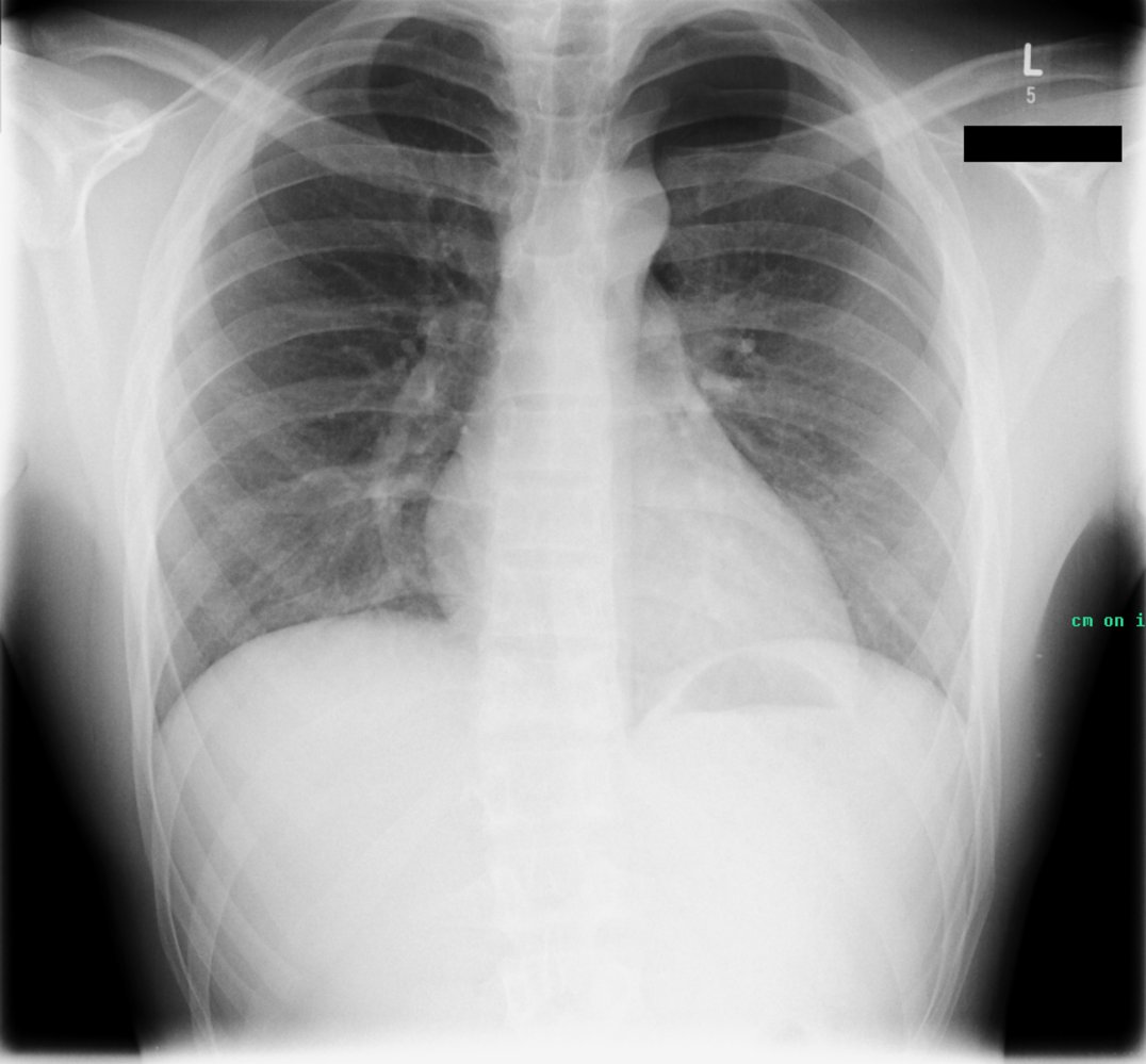 Pneumothorax without tension