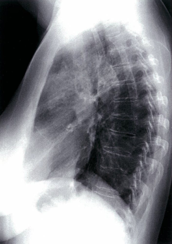 Left upper lobe airspace consolidation 2/2