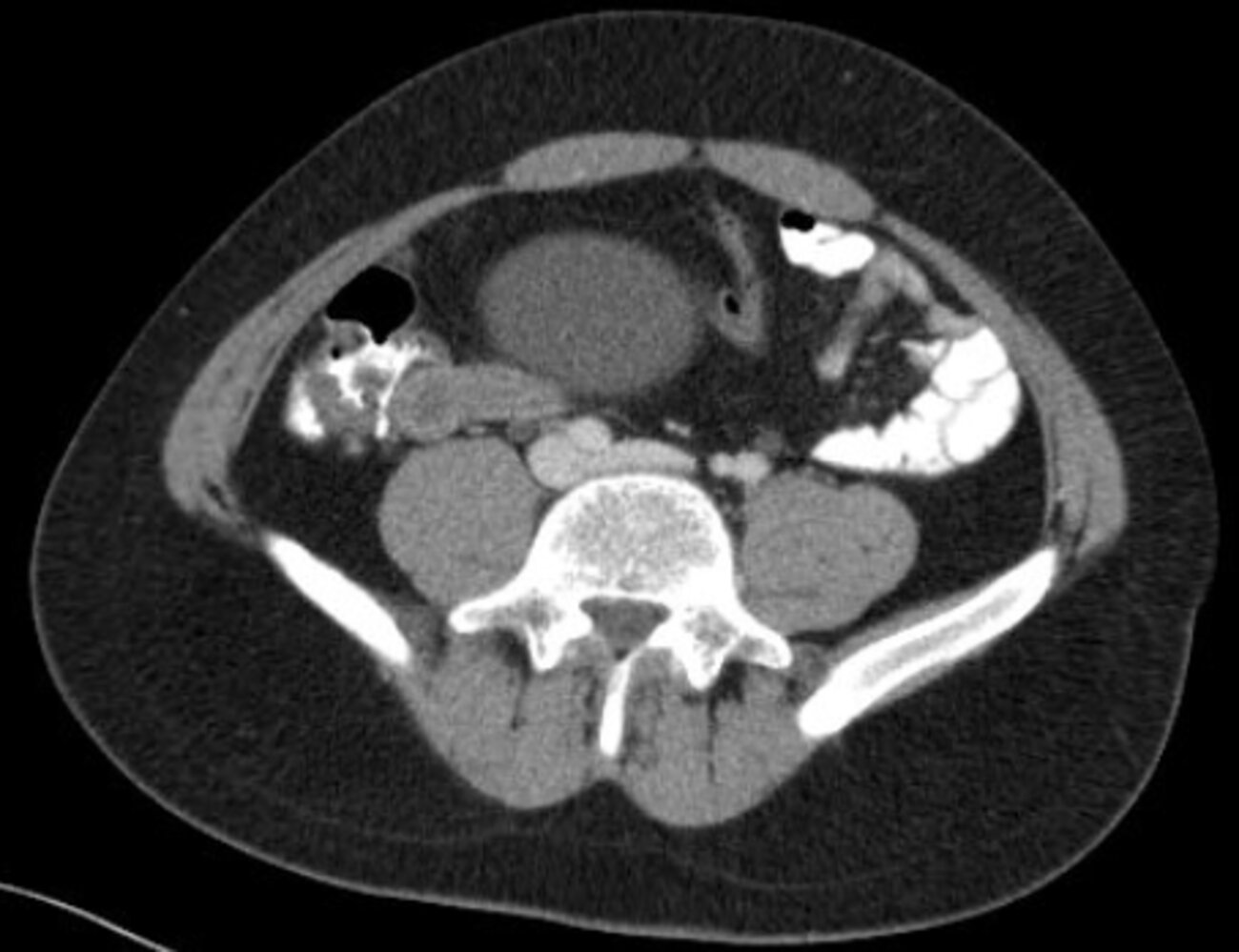 Appendicitis