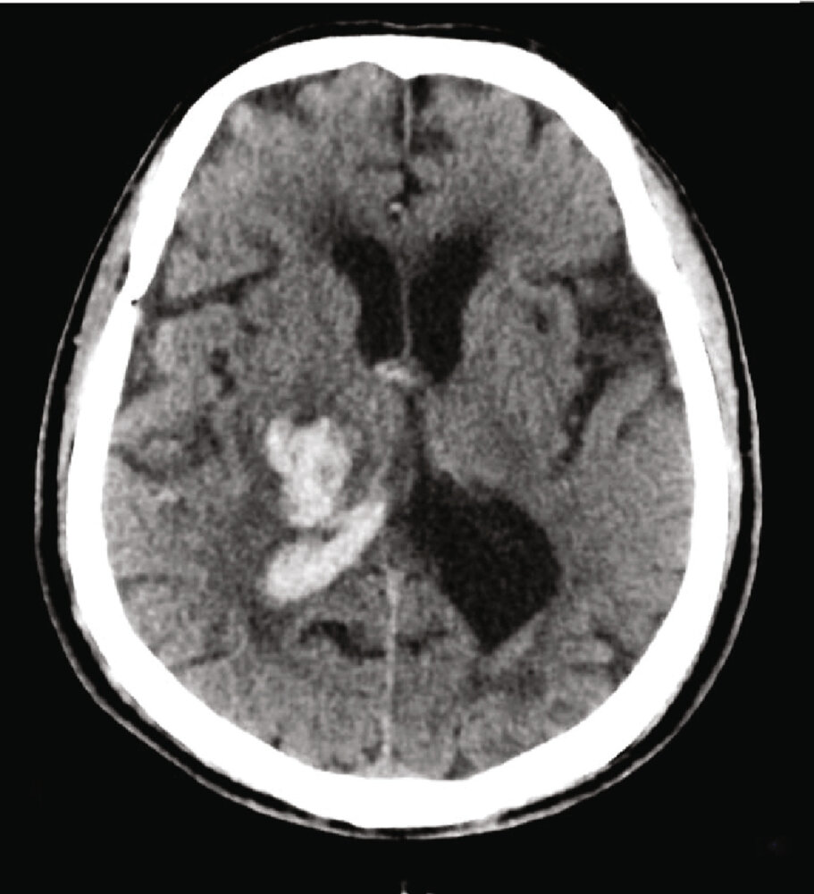 Thalamic hemorrhage