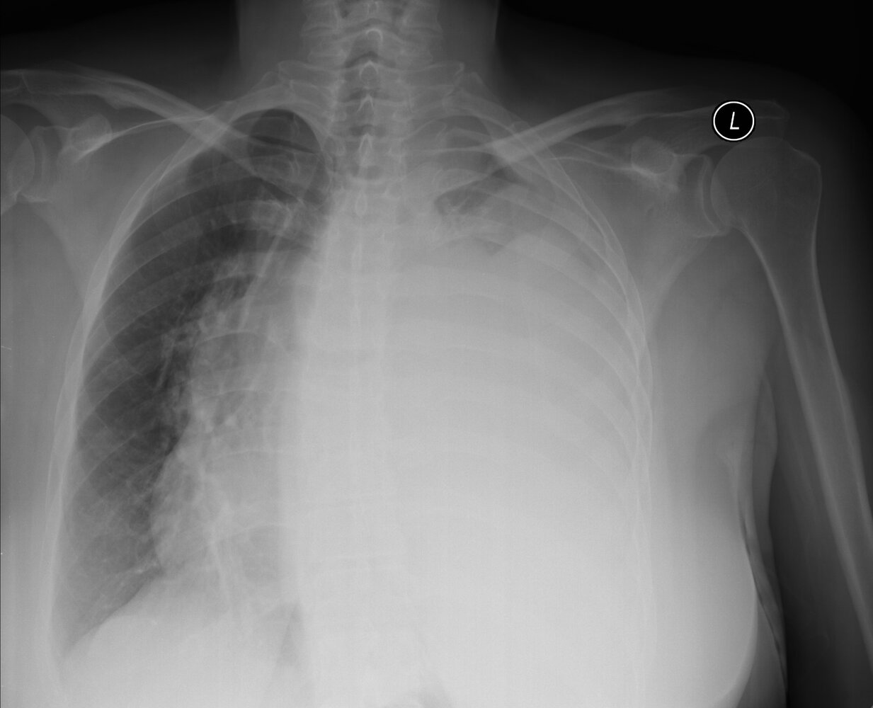 Malignant pleural effusion with contralateral mediastinal shift