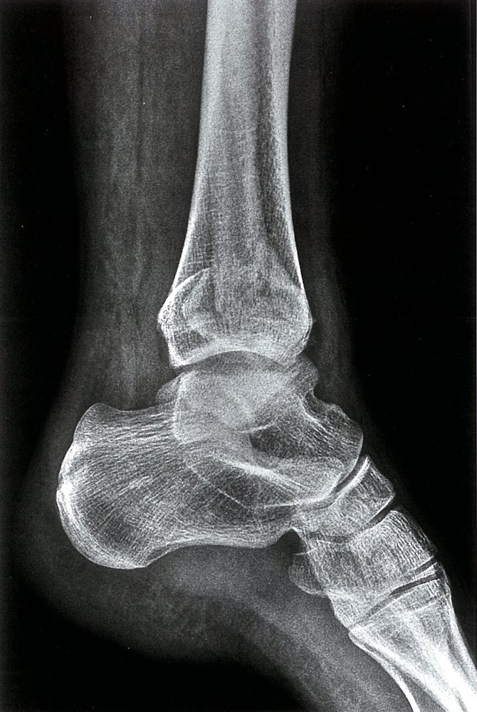 Bimalleolar ankle fracture (2/2)