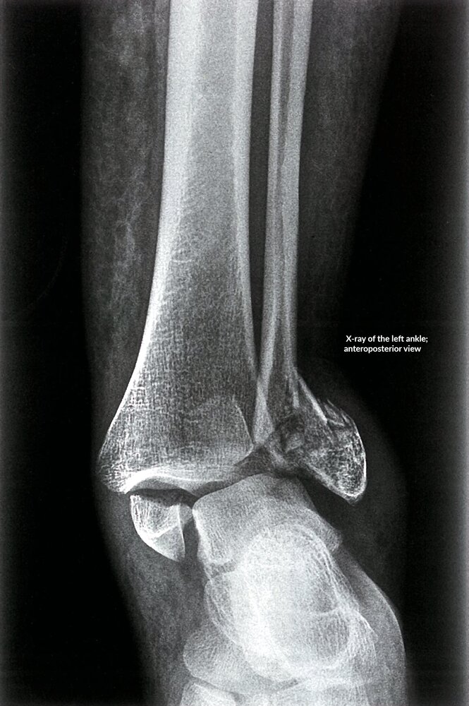 Bimalleolar ankle fracture (1/2)