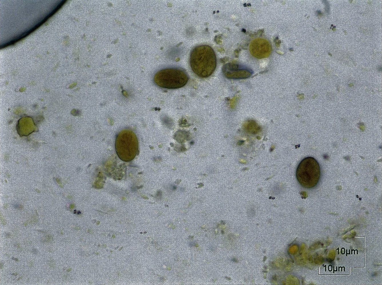 Giardiasis