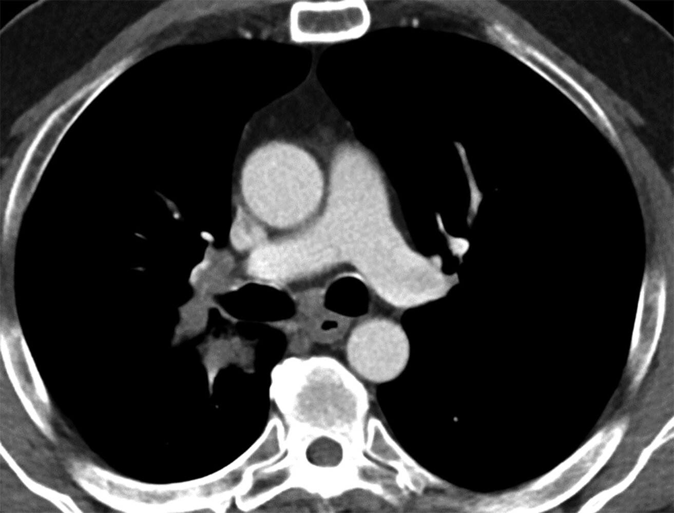 Enlarged lymph nodes in lung cancer