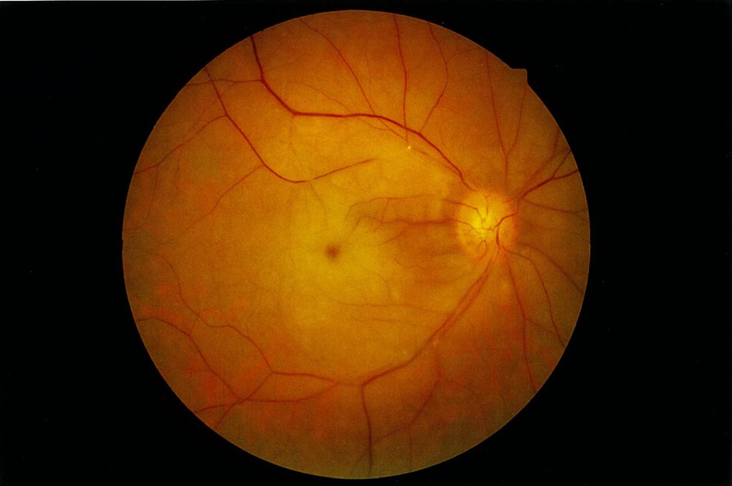 Acute central retinal artery occlusion