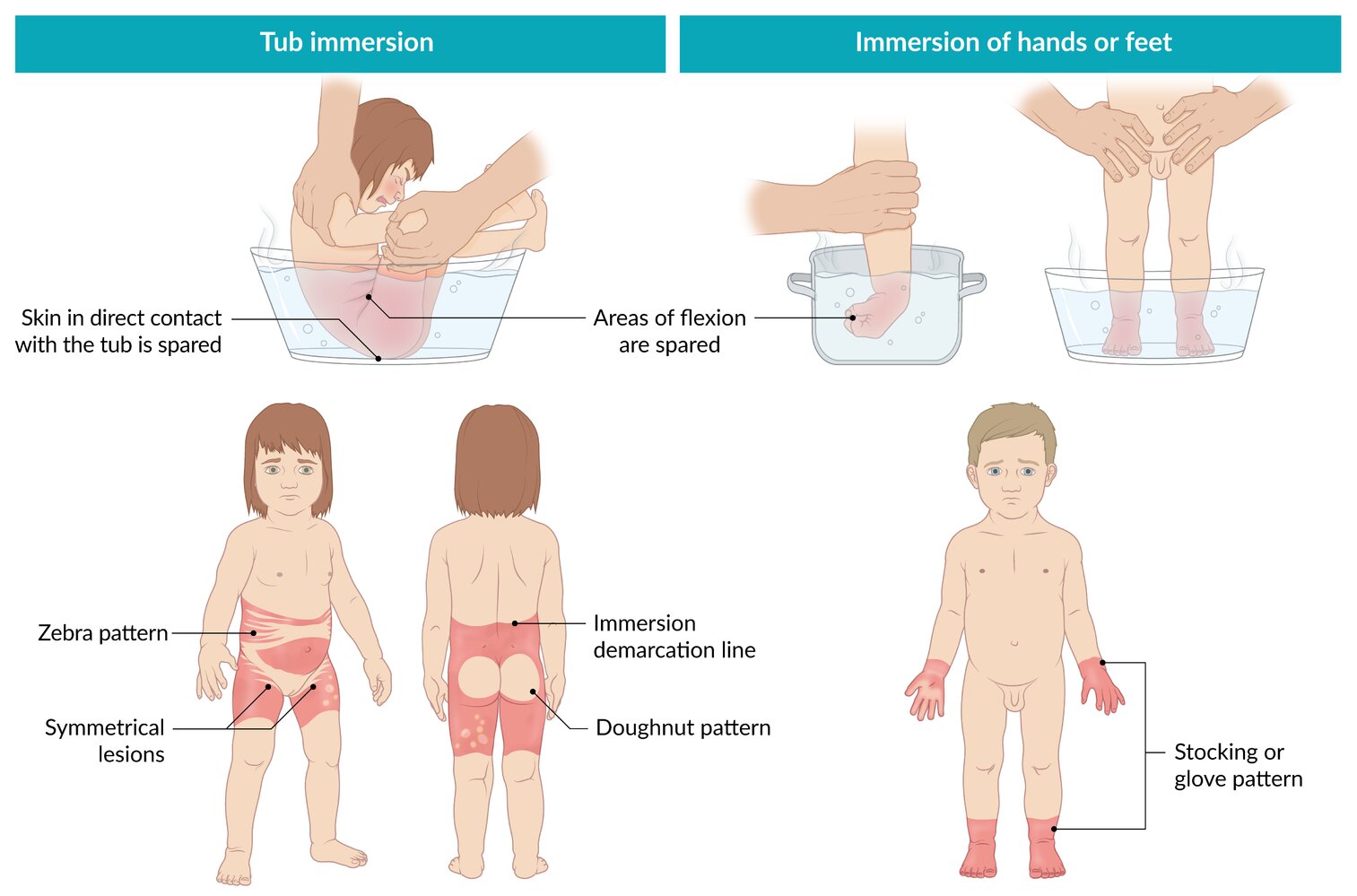 Child maltreatment: immersion scald injuries