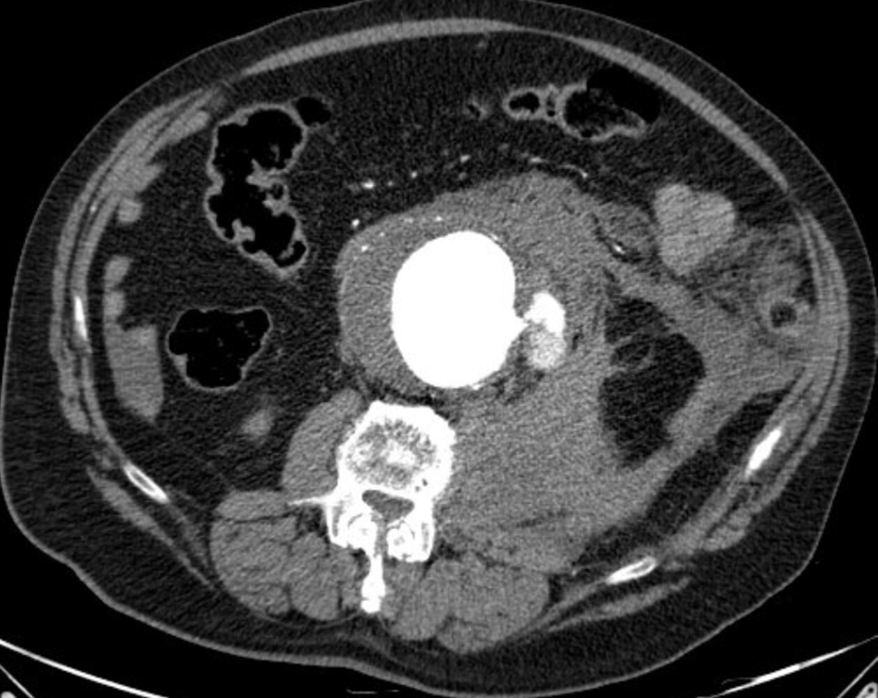 Ruptured aortic aneurysm