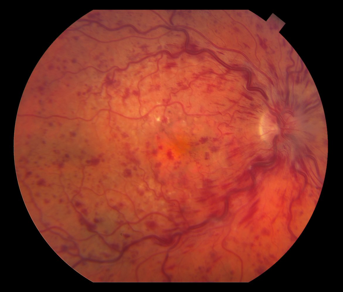 Central retinal vein occlusion