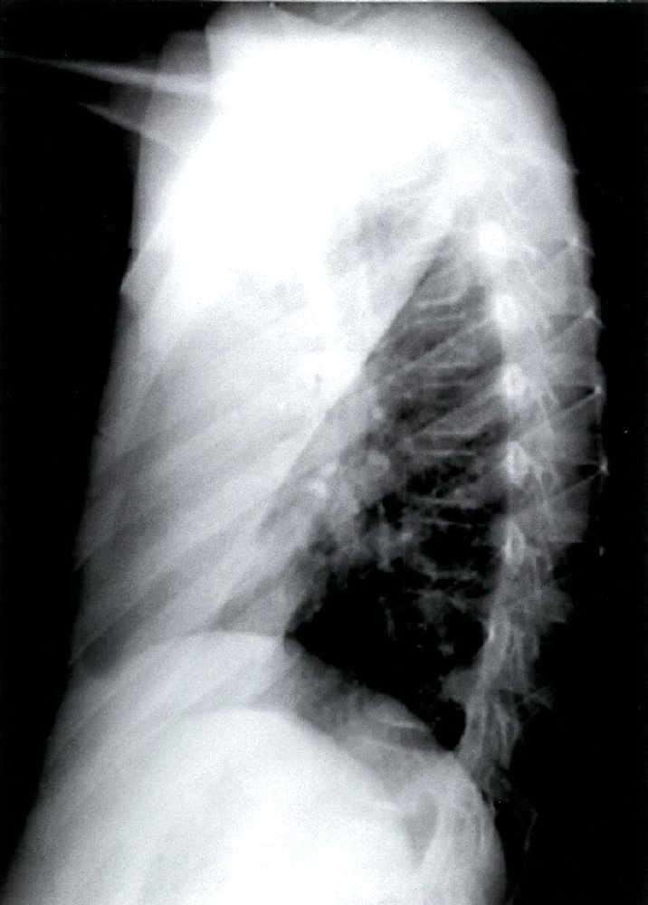 Left upper lobe pneumonia 2/2