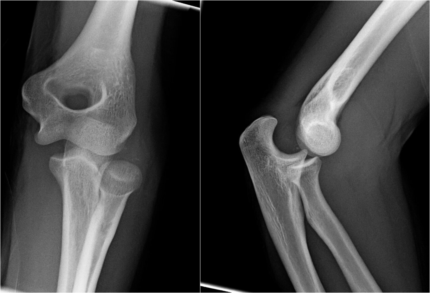 Posterolateral elbow dislocation