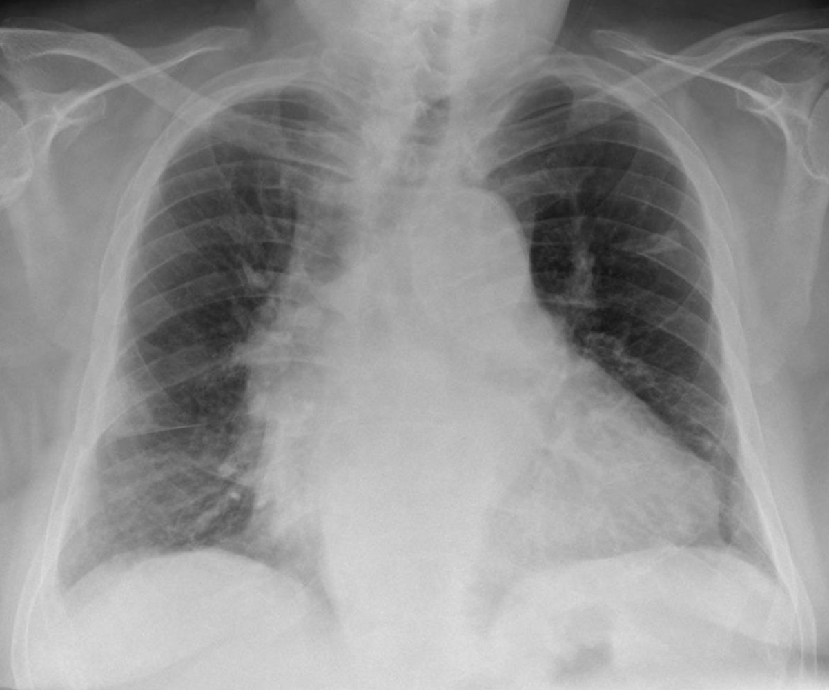 Hampton hump in pulmonary infarction