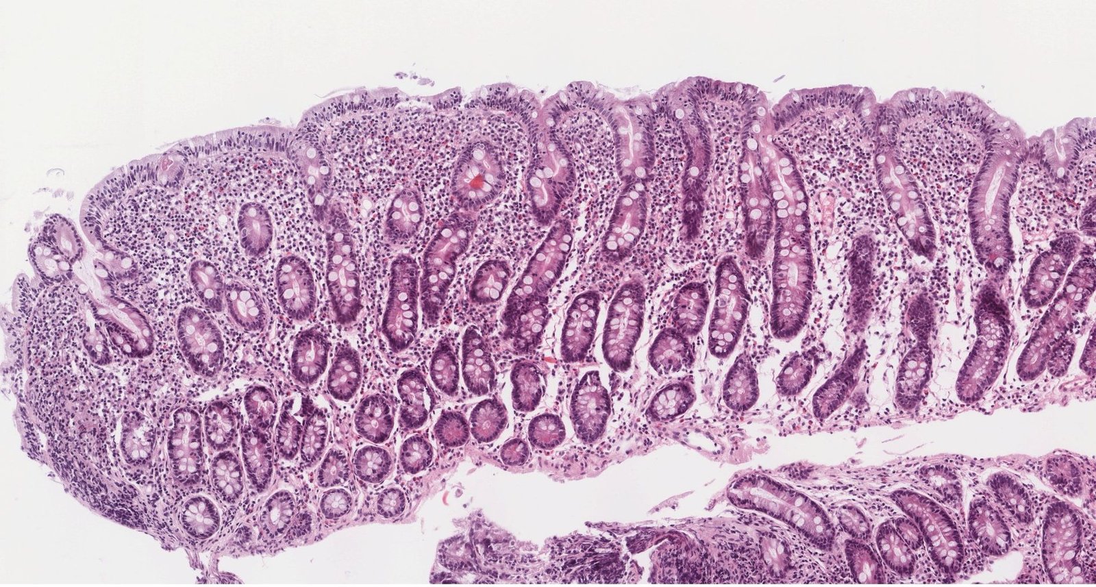 Histopathological changes in celiac disease