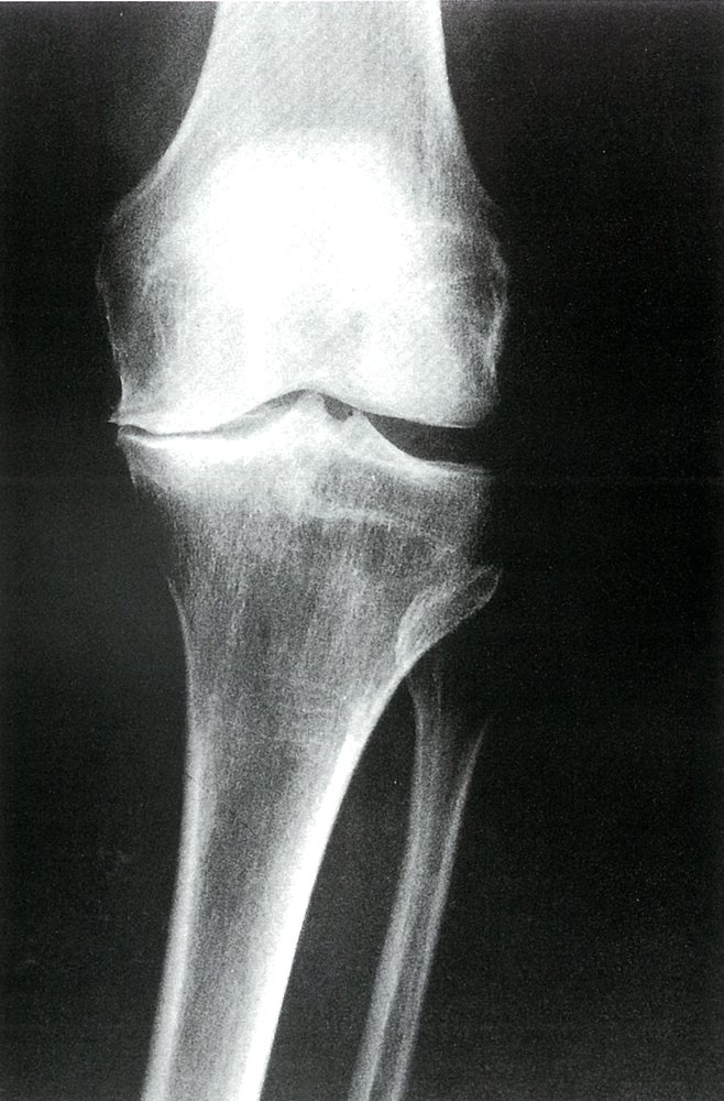 Medial compartment osteoarthritis of the knee