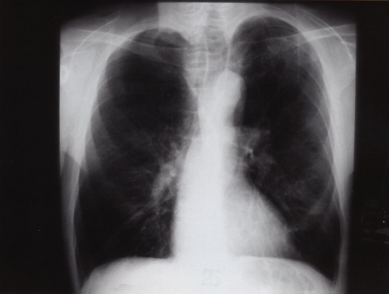 Air trapping in pulmonary emphysema