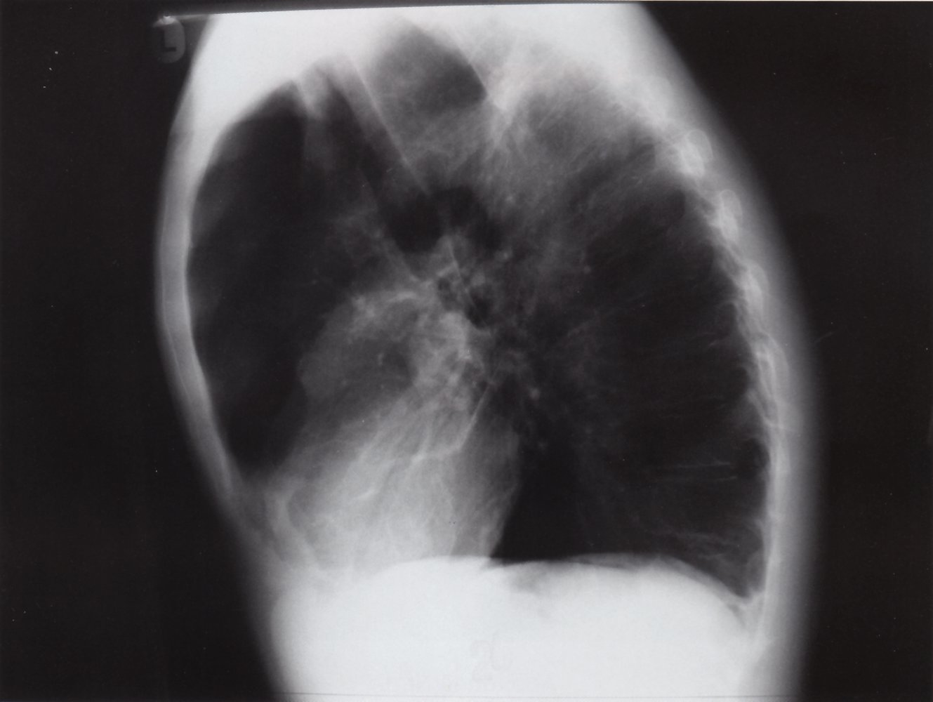 Air trapping in pulmonary emphysema