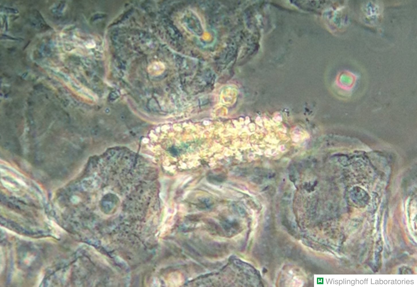 Red blood cell (RBC) casts in urine sediment