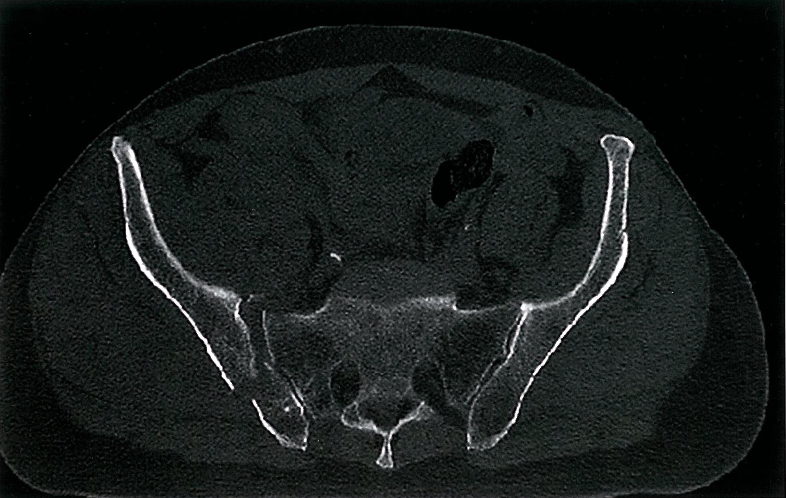 Posterior pelvic ring fracture