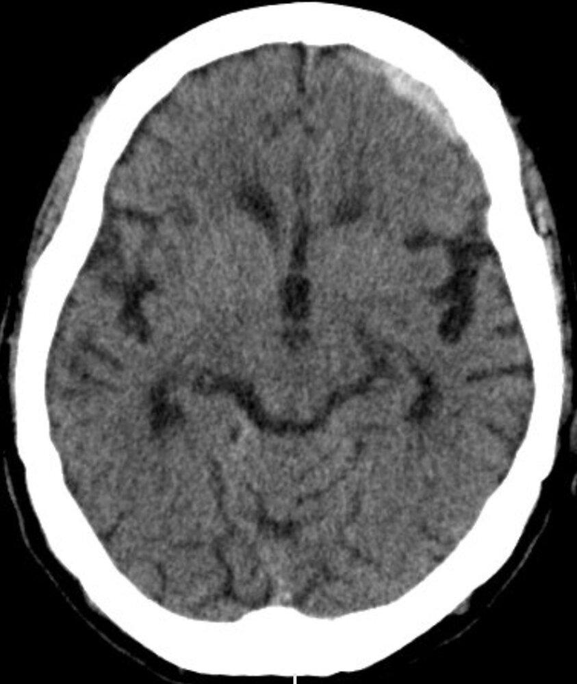 Subdural hematoma