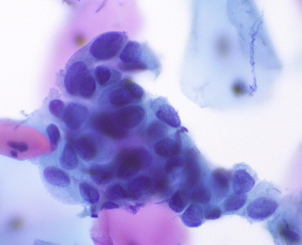 Atypical glandular cells (AGC)