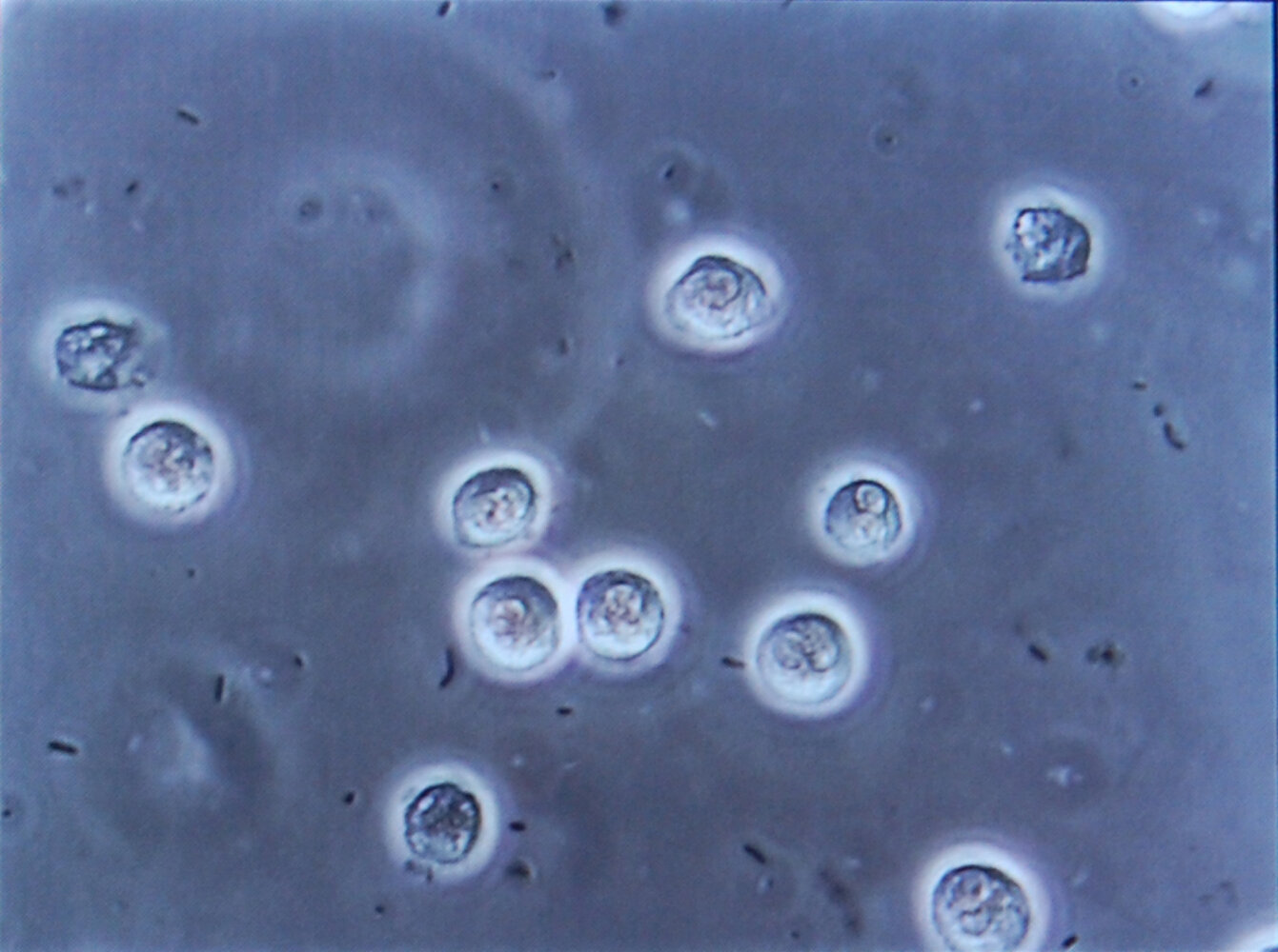 Pyuria and bacteriuria on microscopy