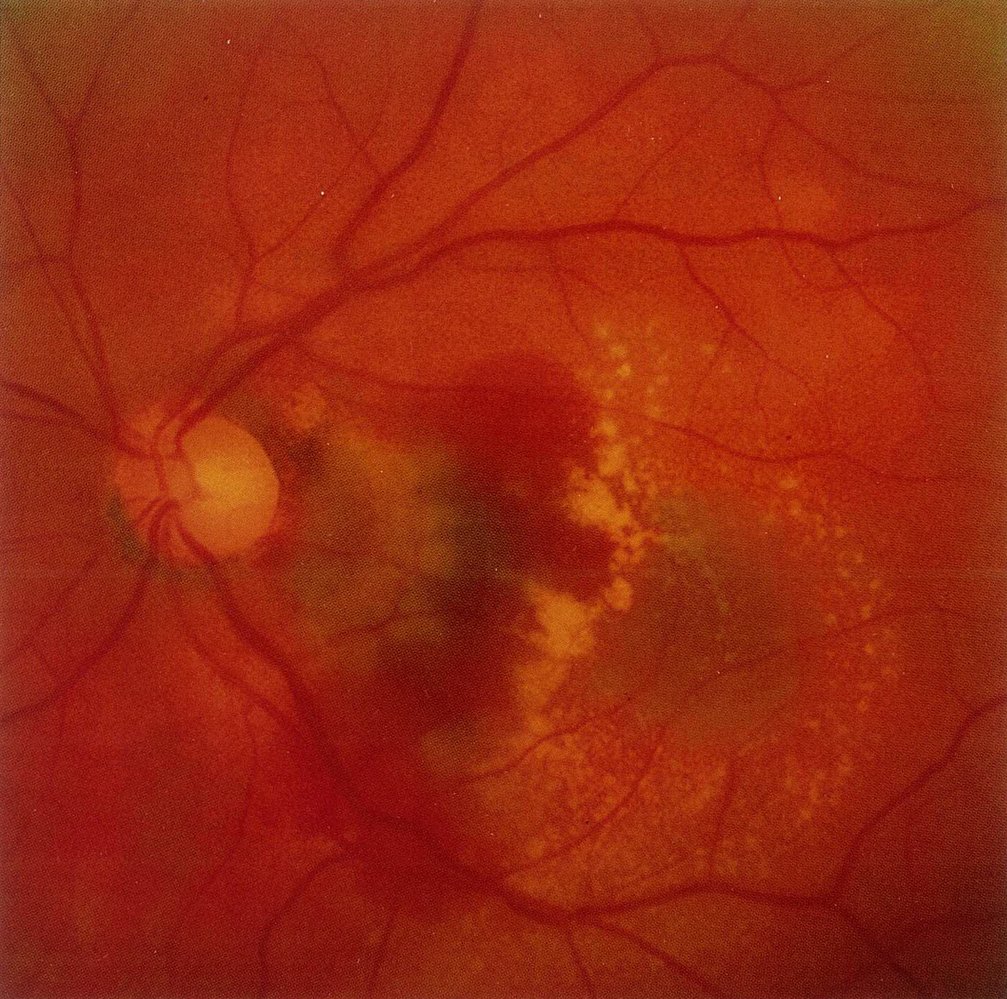 Exudative age-related macular degeneration