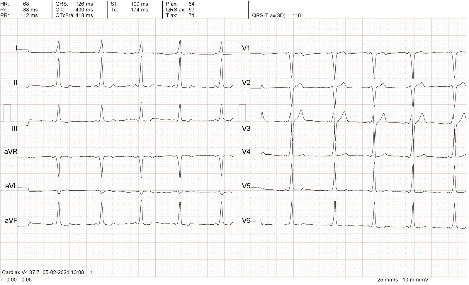Wolff-Parkinson-White syndrome