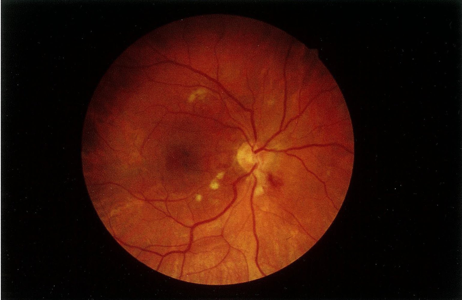 Grade IV hypertensive retinopathy