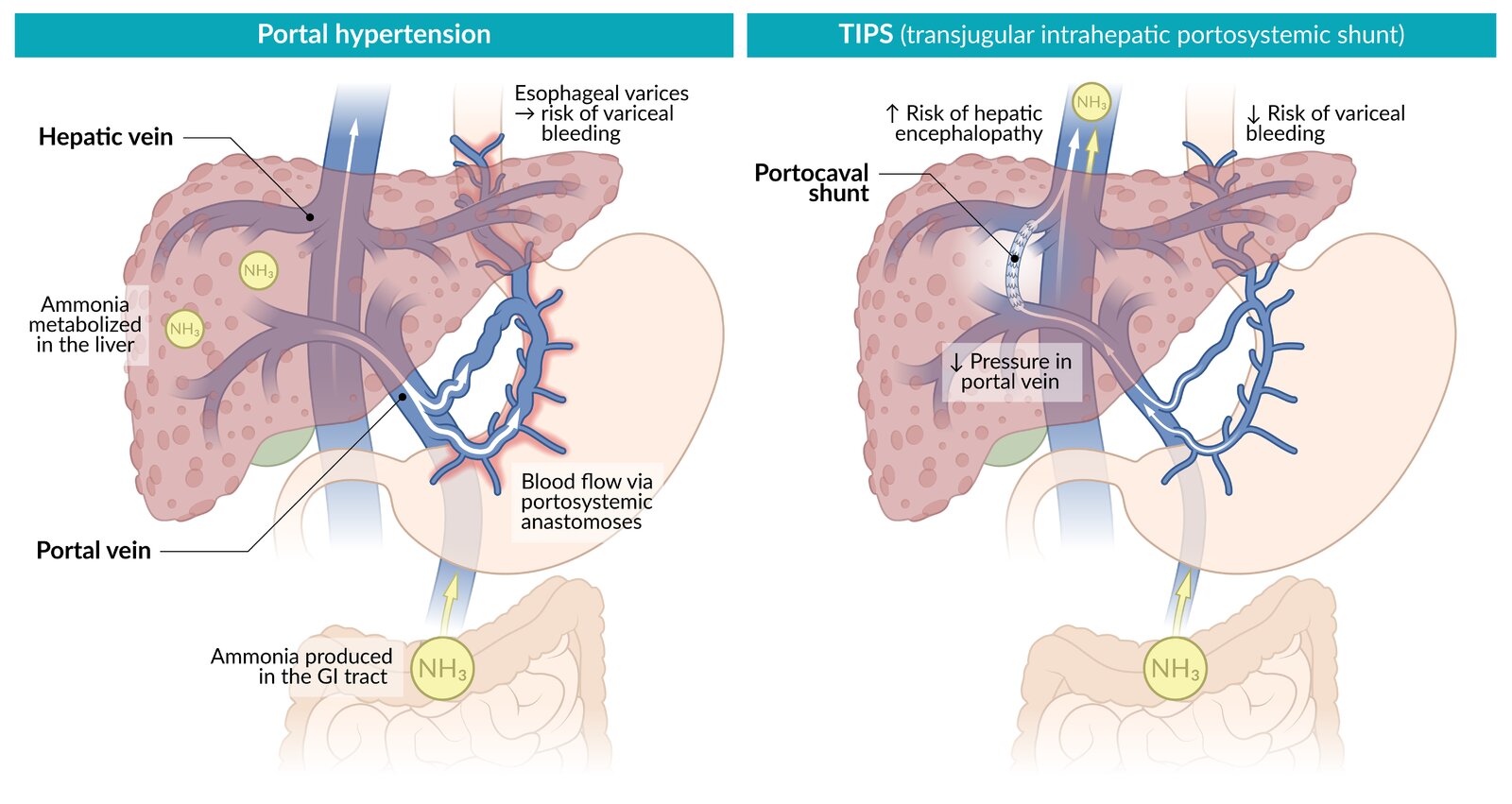 Transjugular intrahepatic portosystemic shunt (TIPS)