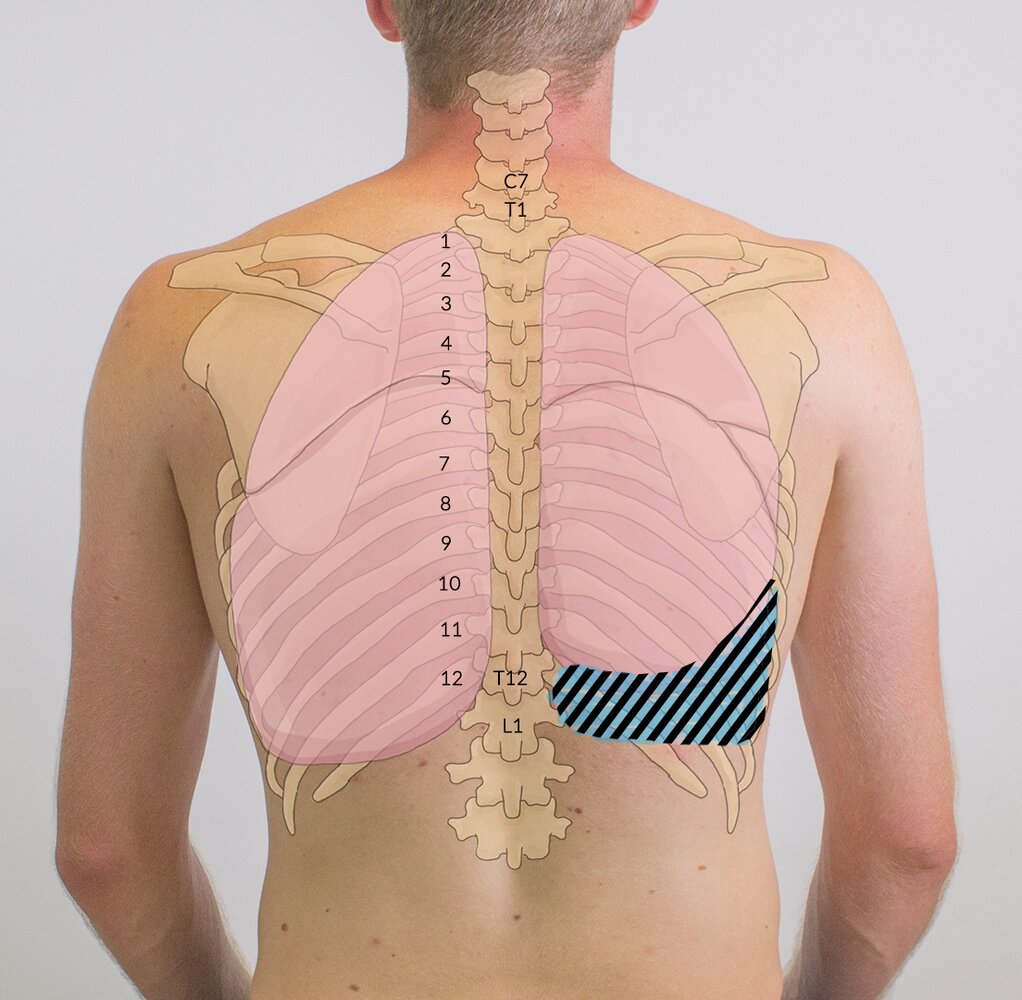 Right pleural effusion